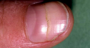 ridges fingernail fingernails abnormalities toenail treatment lunula healthline infection problems fungal splitting rippled hyponychium fungus unhas anormalidades dummies beaus pitted